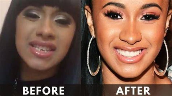 Cardi B's Teeth Transformation A Complete Breakdown