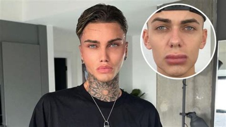 Levi Jed Murphy Before Surgery Photos, Age Height Net Worth