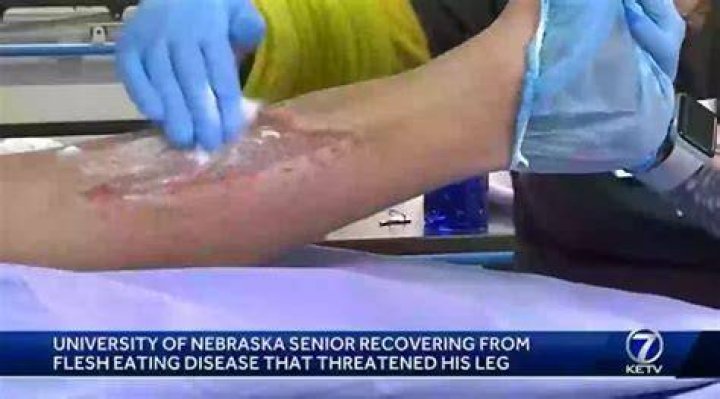 Peyton Robb Skin Infection And Condition Explained – Illness Age And Bio