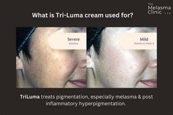 Tri-Luma Transformation: Before And After Unveiled!