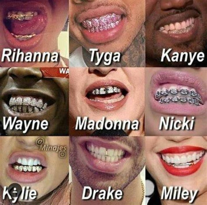 Uncovering The Allure Of "Braces That Look Like Grills"
