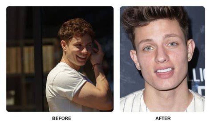 Unveiling Matt Rife's Dental Transformation: A Journey Of Smiles