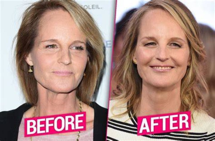 What Happened to Helen Hunt’s Face? The Truth Behind the Plastic Surgery Rumors