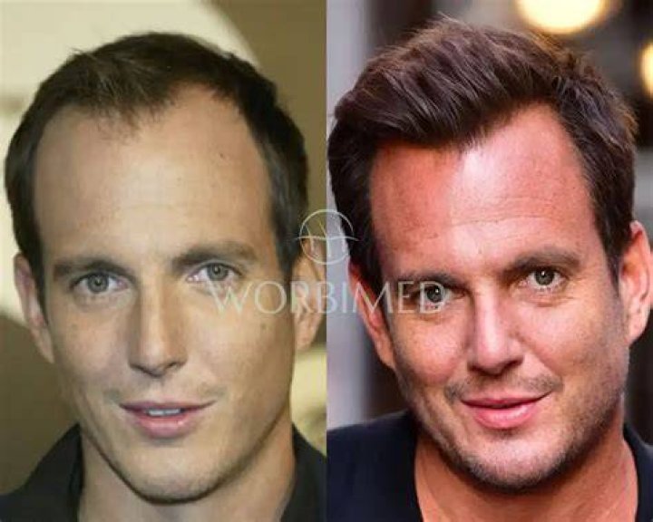 Will Arnett Plastic Surgery Looks Before And After Photos